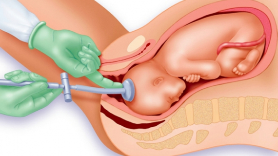 What is Involved if You Need an Assisted Birth (Instrumental Delivery)