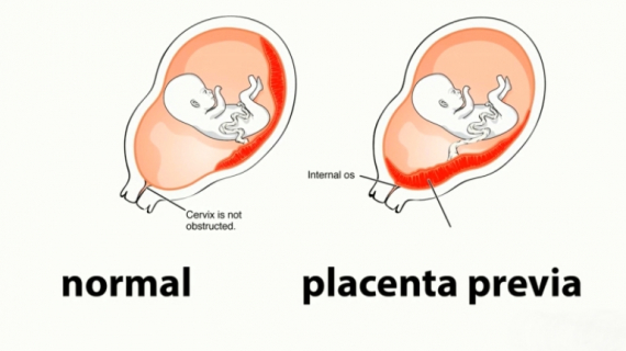 What Types of Birth Require a C-Section?