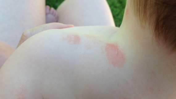 What You Need to Know About Ringworm in Babies